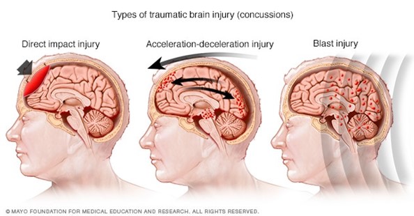 Concussion Types
